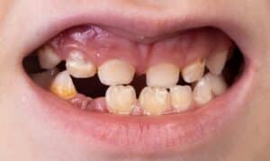 tips for preventing tooth loss from a boynton beach dentist