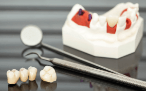 tips for long-term maintenance of dental crowns